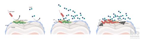 How Bacteria Cause Caries On Your Teeth On Bacterialworld