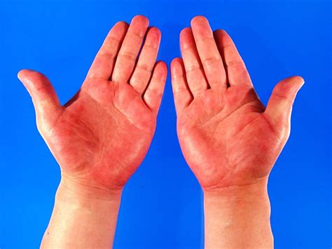 What Your Hands Can Tell You About Your Health Hubpages