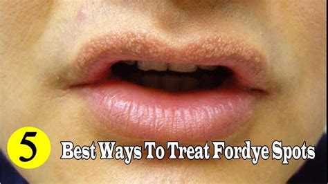 Best Ways To Remove Fordyce Spots Naturally At Home Youtube Youtube