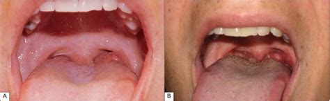 Infections Of The Oropharynx Ento Key