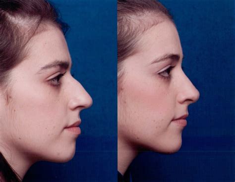 The Nose Clinic Before And After Nose Surgery Photos 56