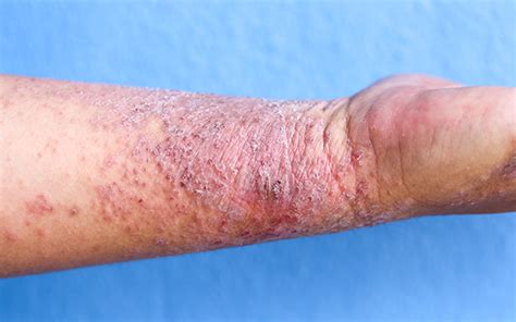 Dupilumab First Biologic For Moderate To Severe Atopic Dermatitis