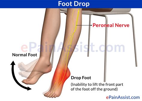 Foot Dropsymptomstreatmentexercisesrecovery