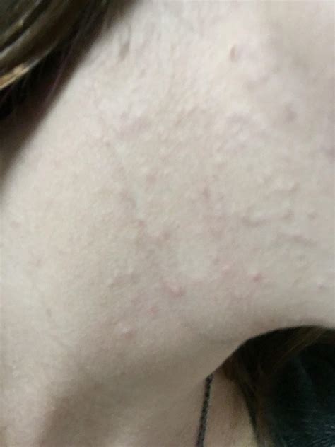 Small Bumps On Cheek General Acne Discussion Forum