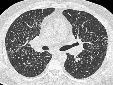 Sarcoidosis Of The Lungs Axial Ct Scan Stock Image C0486206
