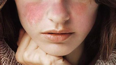 What Is Systemic Lupus Erythematosus