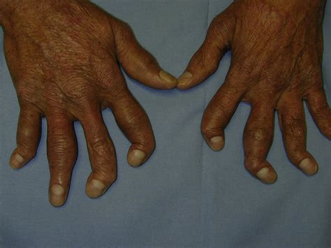 Clinical Features And Diagnostic Considerations In Psoriatic Arthritis