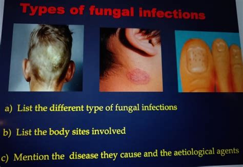 Types Of Fungi That Cause Disease Captions Entry