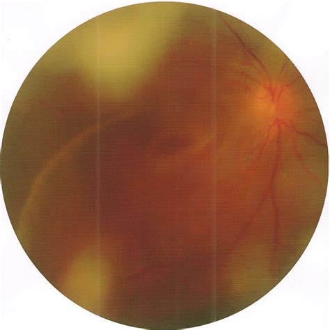 Color Fundus Photograph Of The Right Eye Shows Vitreous Condensations