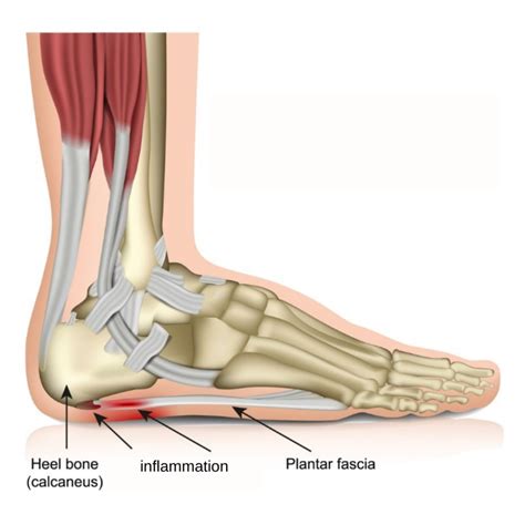 Plantar Fasciitis Pro Motion Physiotherapy Thornhill