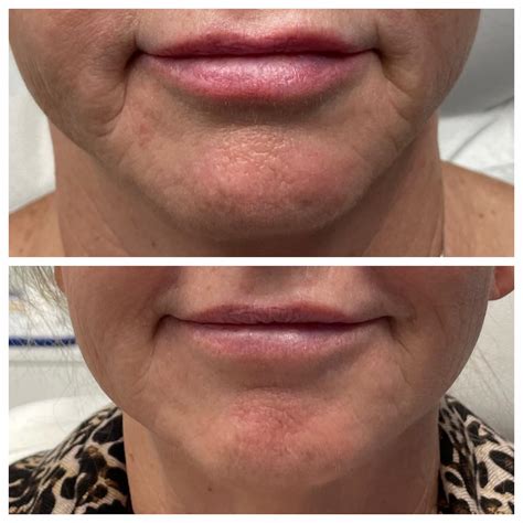Marionette Lines Filler Before And After St Louis