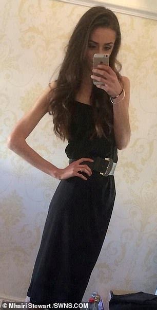 Recovering Anorexic Whose Weight Plummeted To 5st Daily Mail Online