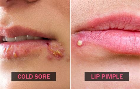 Cold Sores Vs Pimples How They Look Causes Treatment
