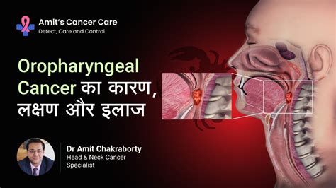 Oropharyngeal Cancer Causes Symptoms And Treatment Explained By Dr