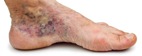 Diabetic Feet - South West Podiatry