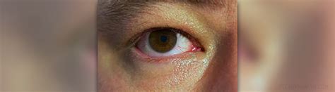Red Dots Under Eyes Face Psoriasis What To Do For Psoriasis Near Eyes