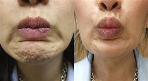 The picture below shows a glaring difference between his old. Botox Results | Dr. Matta