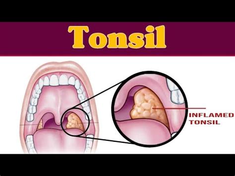 Tonsils And Adenoid Tonsillitis Tonsillectomy Adenoidectomy