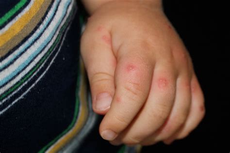 Derm Dx Multiple Erythematous Pustules On A Toddlers Hands Clinical
