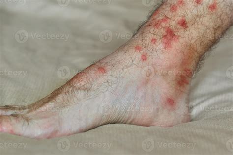 Allergic Reaction To Insect Bites Male Foot With Many Red Spot And