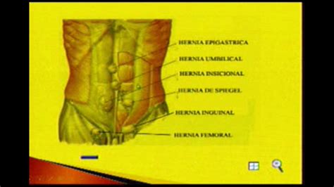 Hernias Abdominales Youtube