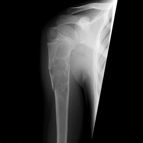 Unicameral Bone Cyst With Fracture Image