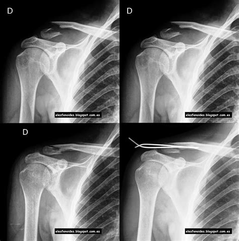 El Esfenoides Fractura De Clavícula 2 Imágenes 1 Caso