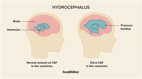 Hydrocephalus Symptoms Causes And Treatment