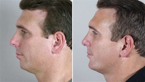 Patients Of The Month For October 2011 Chin Implants For Men And