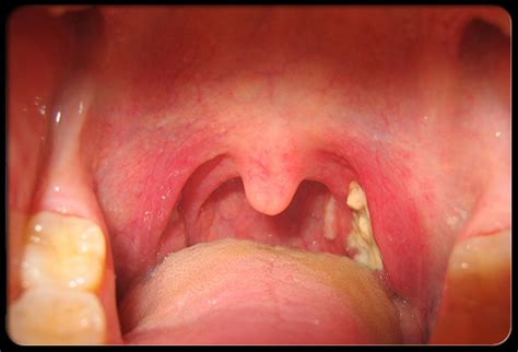 Mononucleosis, or mono, is a viral infection that causes fever, sore throat, and swollen lymph glands, most often in the neck. Mononucleosis