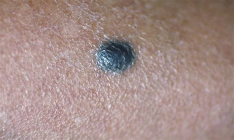 How To Tell If You Have A Bad Mole Where Wellness