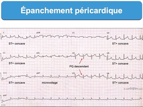 Nos coups de coeur sur les routes de france. Épanchement péricardique : e-cardiogram