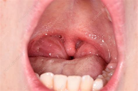 Tonsillitis In A Child Stock Image C0381583 Science Photo Library