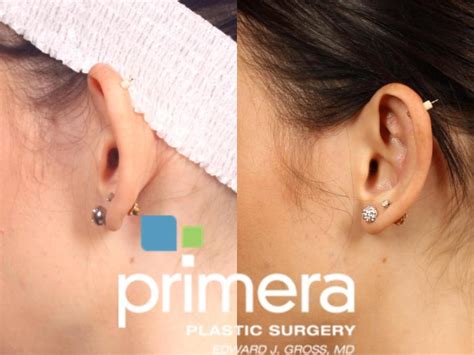 Ear Surgery Otoplasty Before And After Pictures Case 517 Orlando