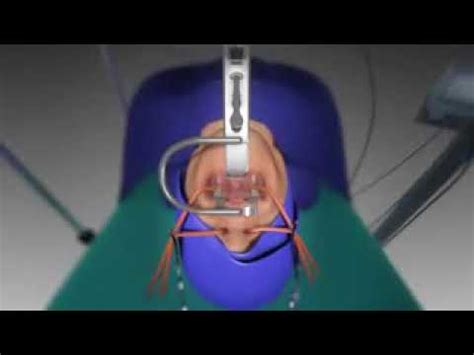 Tonsil Adenoid Animated Video Youtube