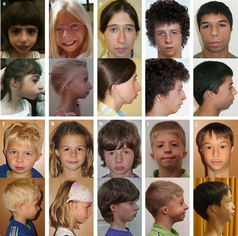 Facial Features Of Individuals With Meiergorlin Syndrome Frontal And