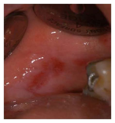 Oral Lichen Planus On Left Buccal Mucosa Visualised With Identafi Using