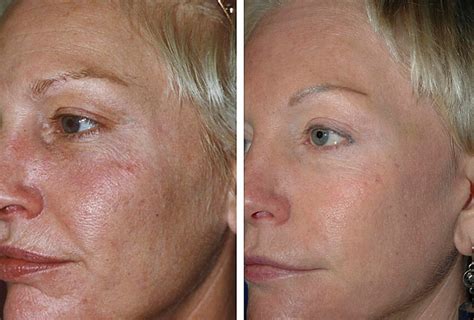 Groupons For Laser Resurfacing