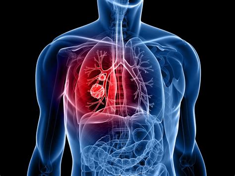 11 Early Warning Signs Of Lung Cancer You Should Know