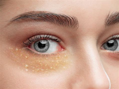 Milia Under Eye Treatment Causes And Prevention In India Mfine