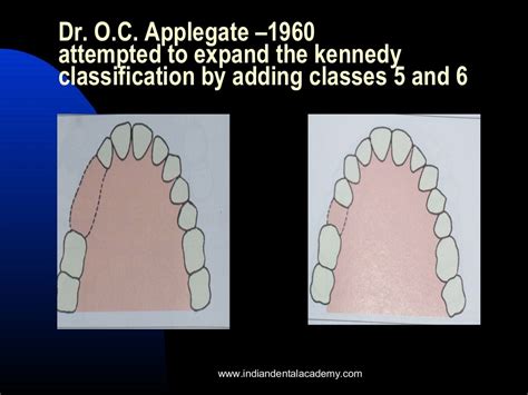 Classification System For Partially Edentulous Arches Dental Implan