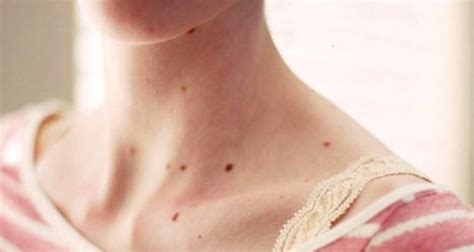 Red Spots On Your Skin