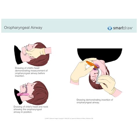 Oropharyngeal Airway