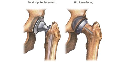 Hip Resurfacing Vs Total Arthroplasty New Data Orthopedics This Week