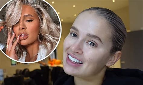 Molly Mae Hague Unveils The Results Of Her Dissolved Filler After