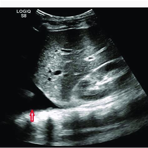 Ultrasound Chest Suggesting Pleural Effusion Left Side Download