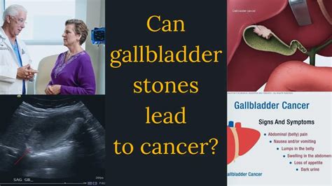 Gallbladder Cancer Symptoms Causes Diagnosis Treatment