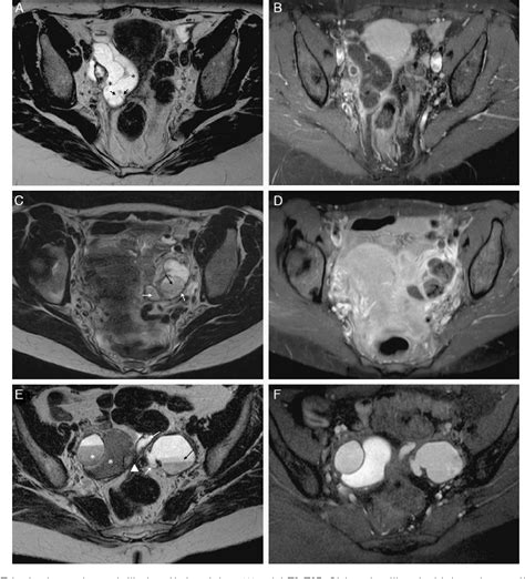 Figure 1 From Fallopian Tube Disease On Magnetic Resonance Imaging