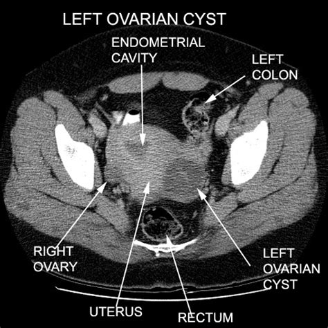 Uterine most cancers Pathophysiology
