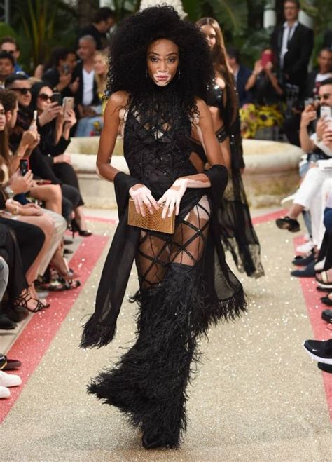 Kisah Inspiratif Winnie Harlow Dengan Kelainan Vitiligo Hingga Menjadi